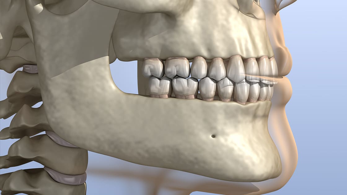 Dental Bone Grafts 