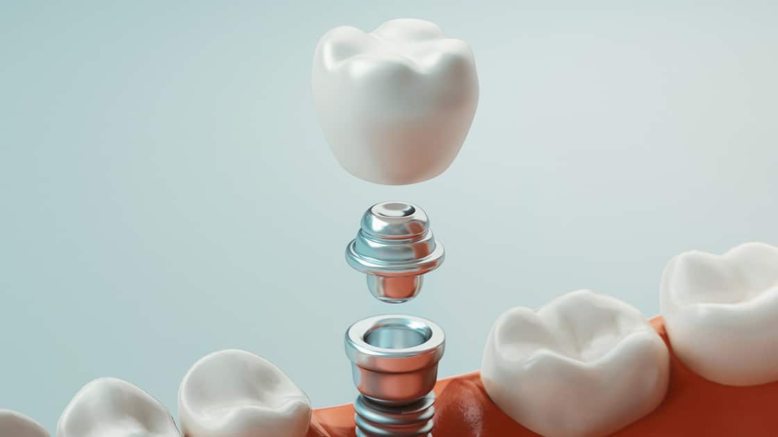 Dental Implants 