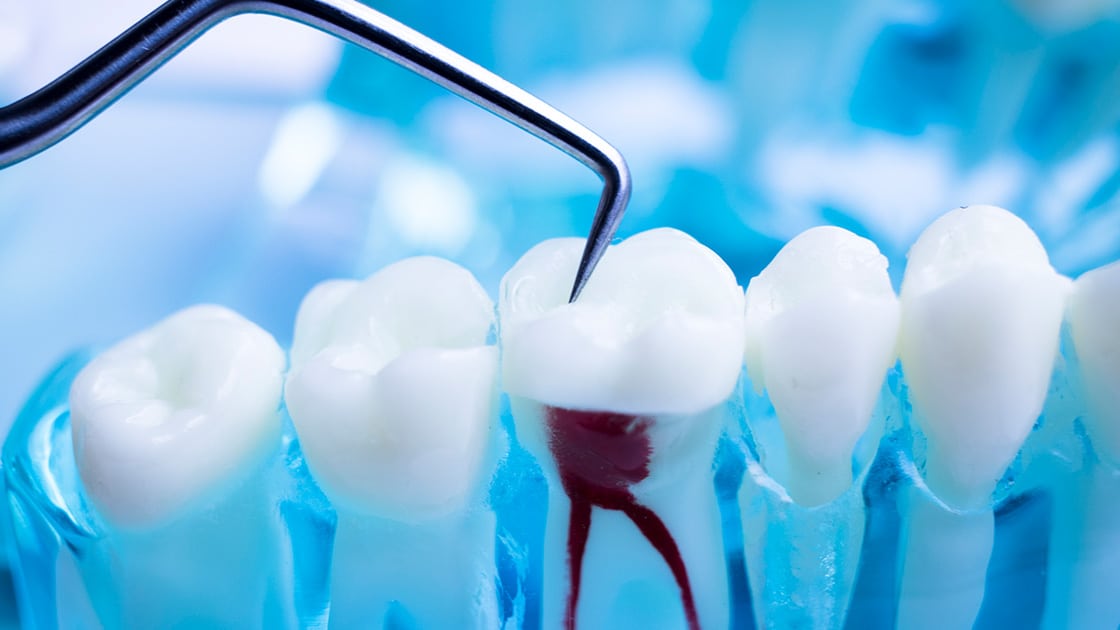Endodontic Retreatment 