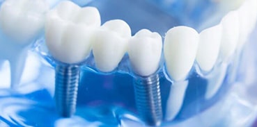 Dental Implants 