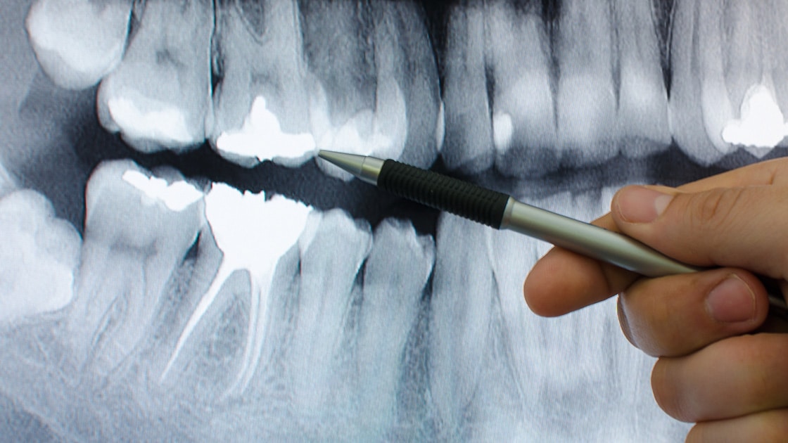 Dental Instruments for Root Canal